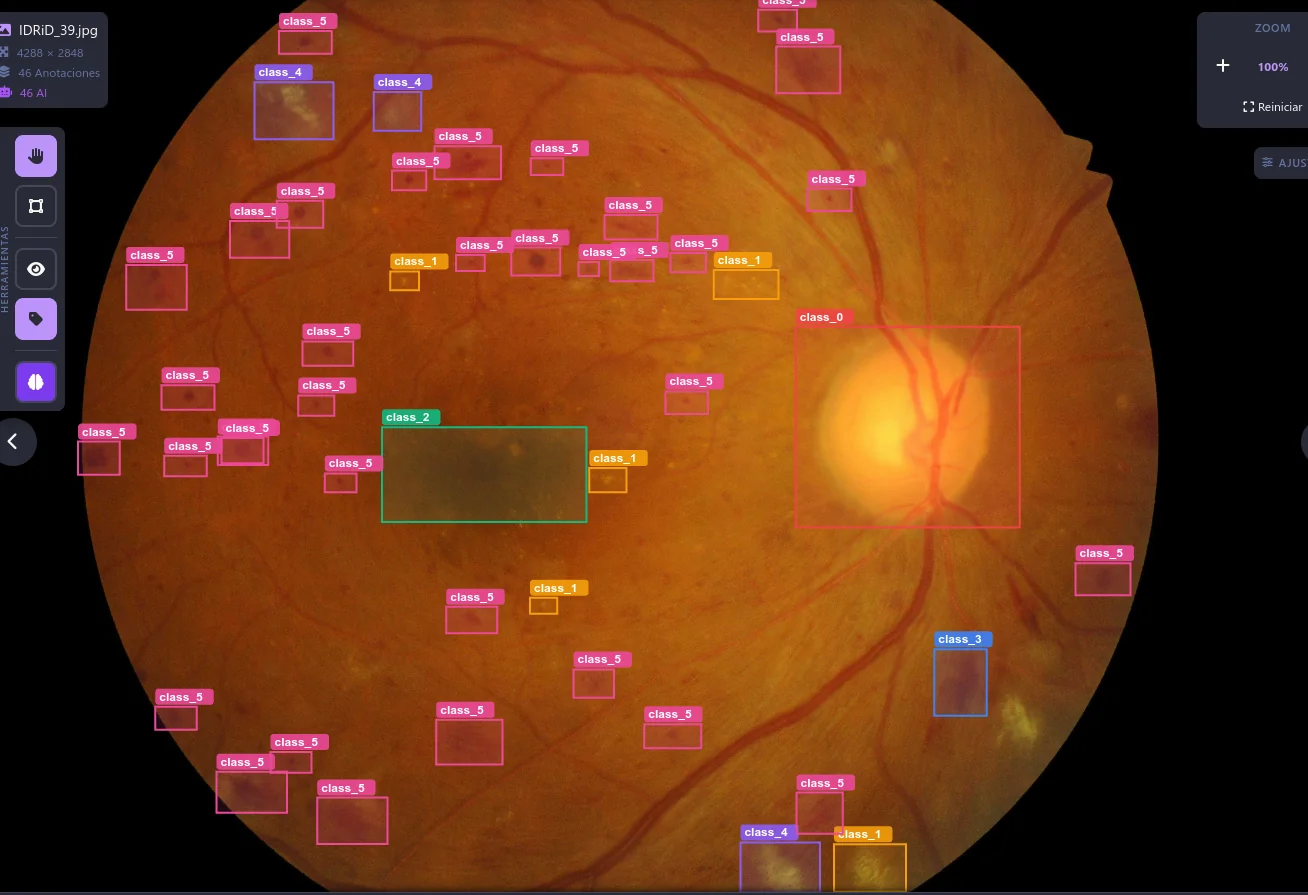 Lesion detection on fundus image
