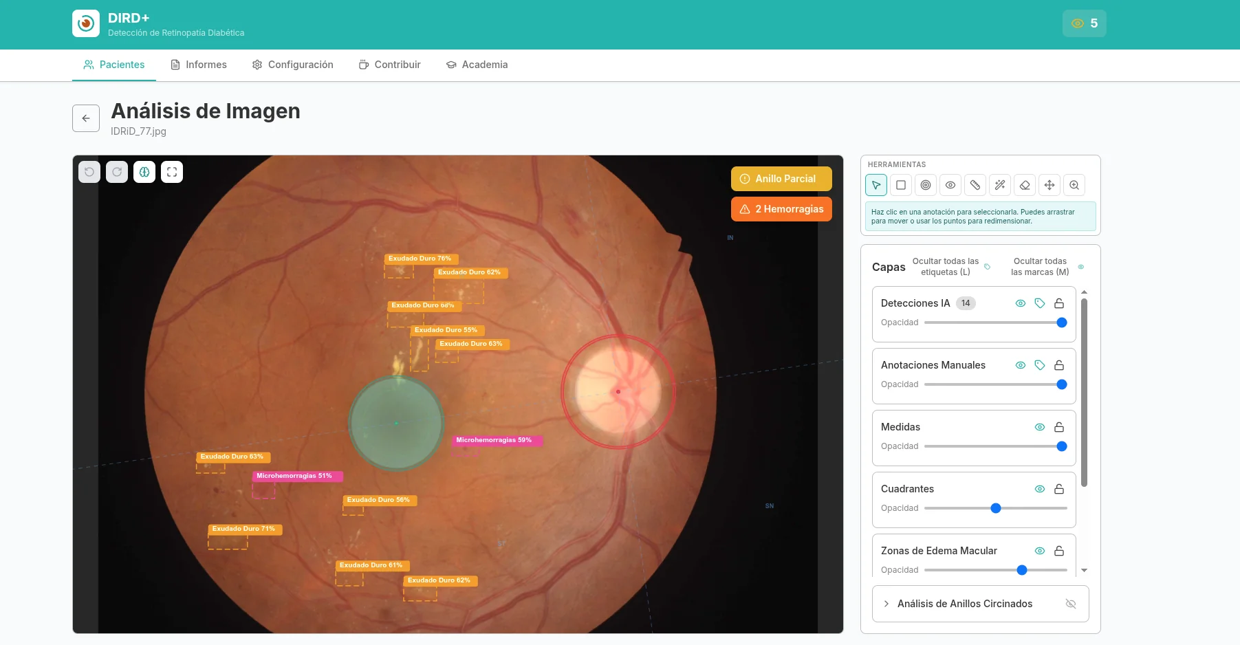 DIRD+ — Main view with lesion detections